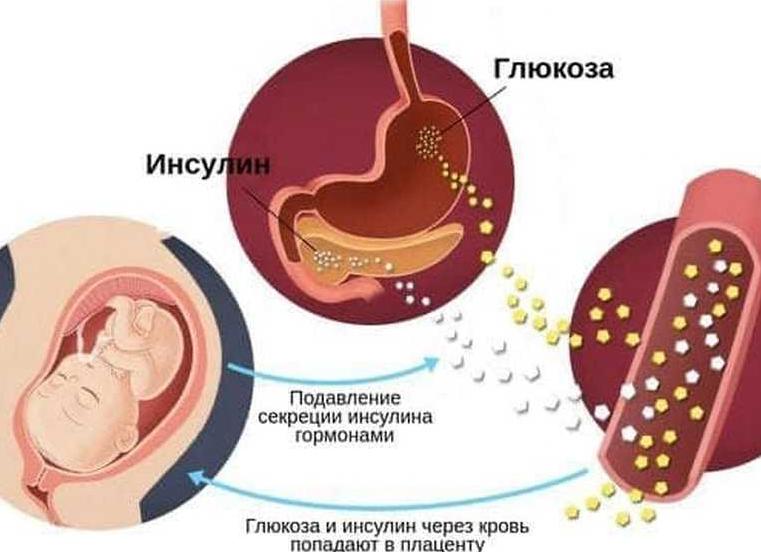 Диабет и беременность — какие риски для мамы и малыша