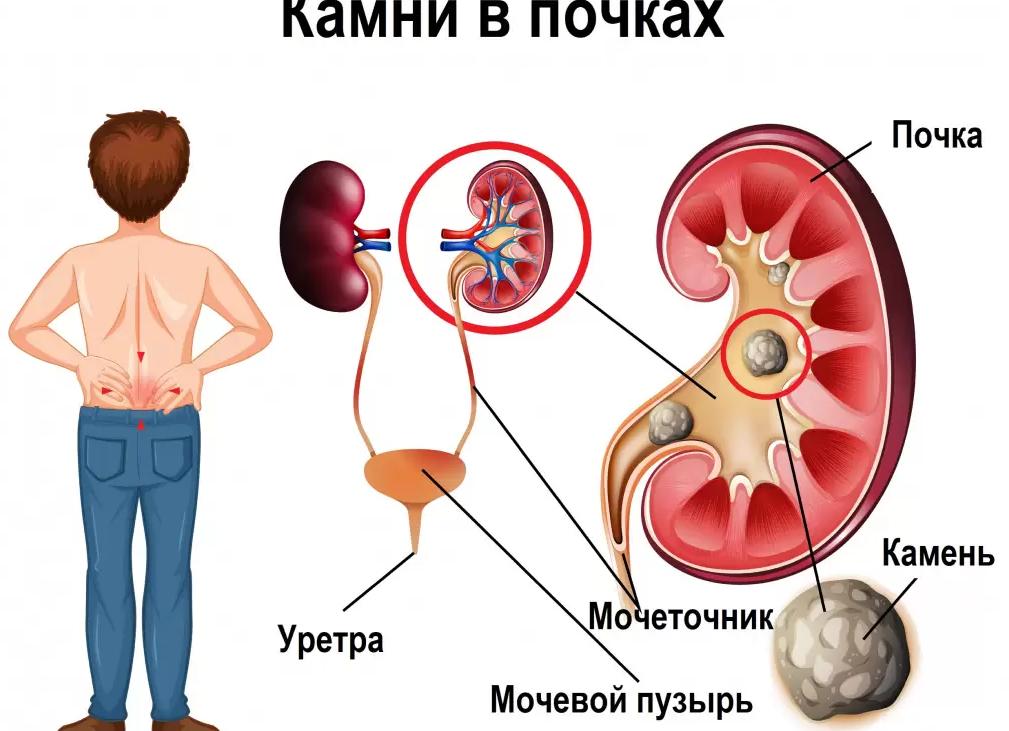 Как не допустить появления камней в почках?
