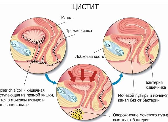 Цистит и его признаки
