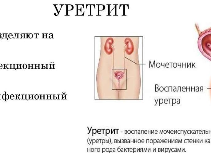 Диагностика и предотвращение уретрита