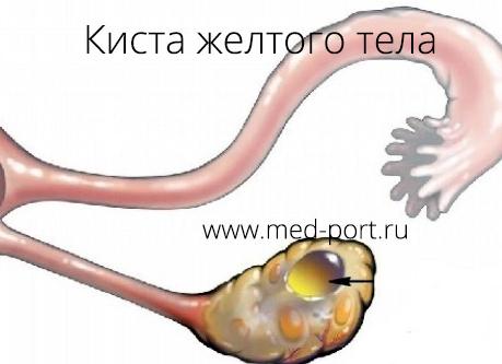 Киста желтого тела. Причины, симптомы, лечение