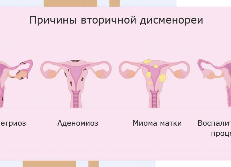Альгодисменорея: причины, виды