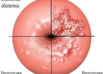 Онкогенный ВПЧ высокого риска: в чём опасность?