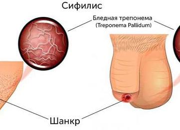 Поцелуй Венеры: как проявляется сифилис