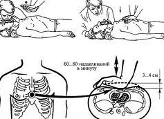 Первая помощь: как делать массаж сердца и искуссвенное дыхание